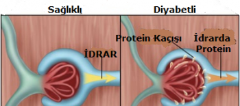 Mikroalbümin İdrar Testi Nedir?