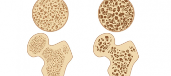 Kırılgan Kemikler ( Osteoporoz )