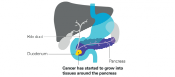 Yüksek insülin pankreas kanserinde rol oynayabilir?