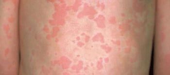 Alerjiler Nedir ? Alerji Testi Çeşitleri Nelerdir ? Alerji Testi Ne Zaman Yaptırmalıyım <*